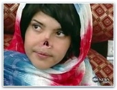 Врачи вернули нос 19-летней Айше, изуродованной мужем талибом | ФОТОРЕПОРТАЖ