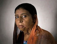 Врачи вернули нос 19-летней Айше, изуродованной мужем талибом | ФОТОРЕПОРТАЖ