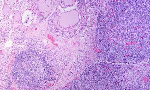 Unike metabolske profiler knyttet til Hashimotos-antistoffer
